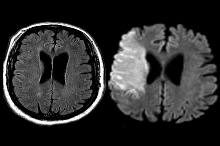 flair DWI ct scan سکته مغزی